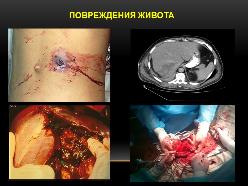 ПОВРЕЖДЕНИЯ ЖИВОТА